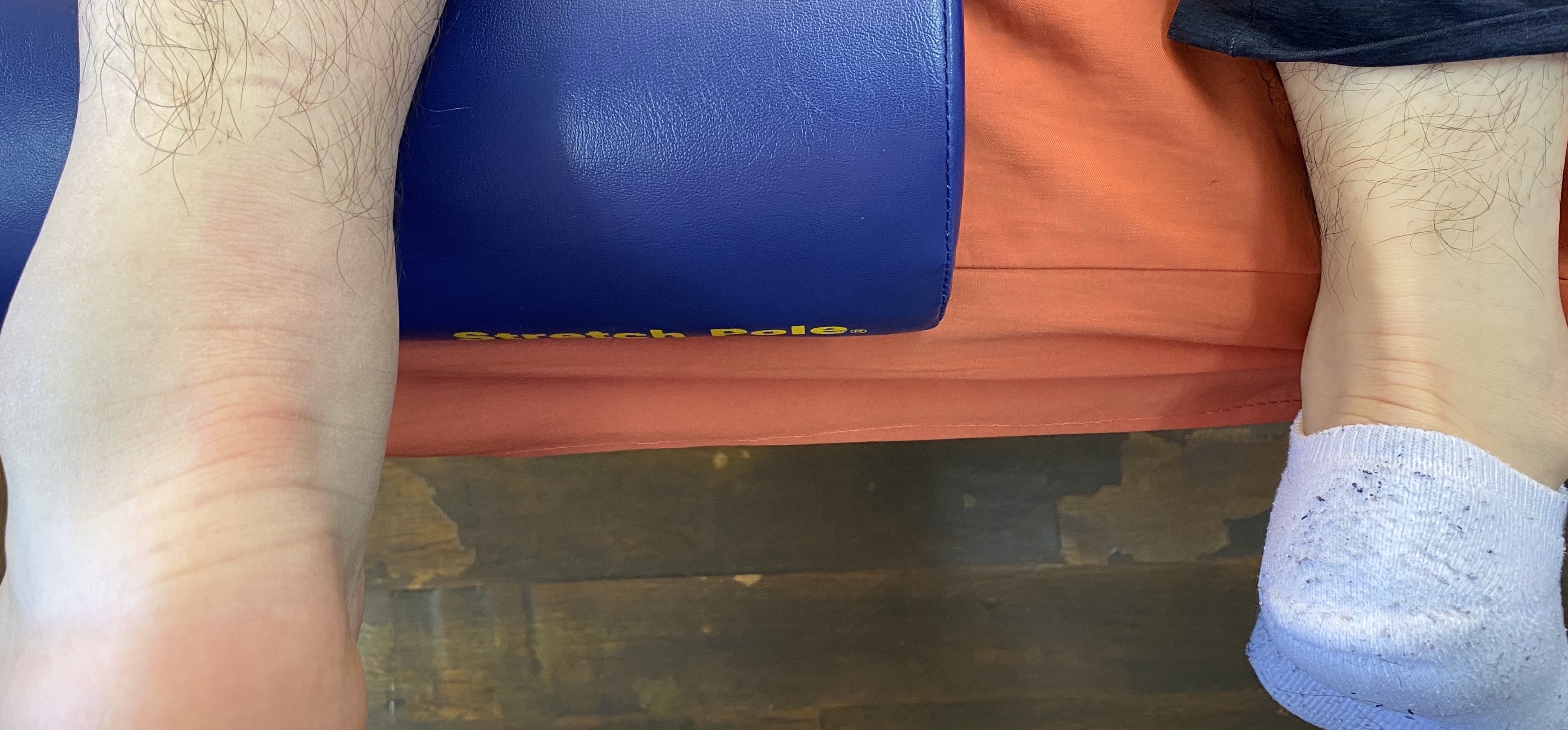 新鮮アキレス腱断裂手術を回避して保存療法で早期仕事復帰ー永田接骨院