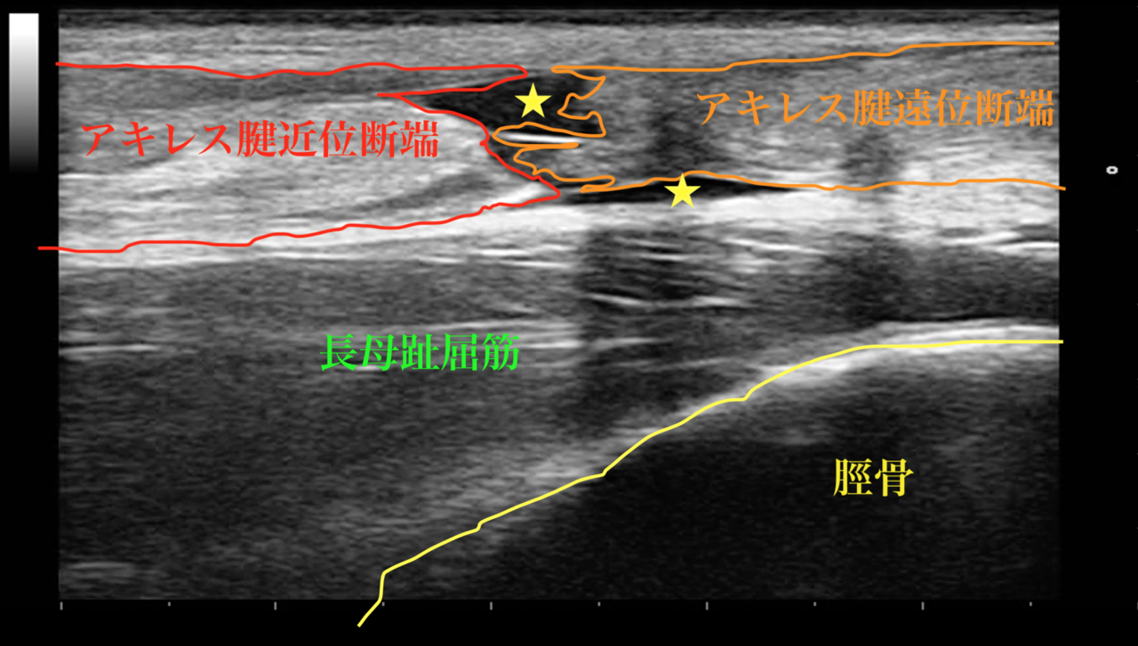 アキレス腱断裂後のエコー画像