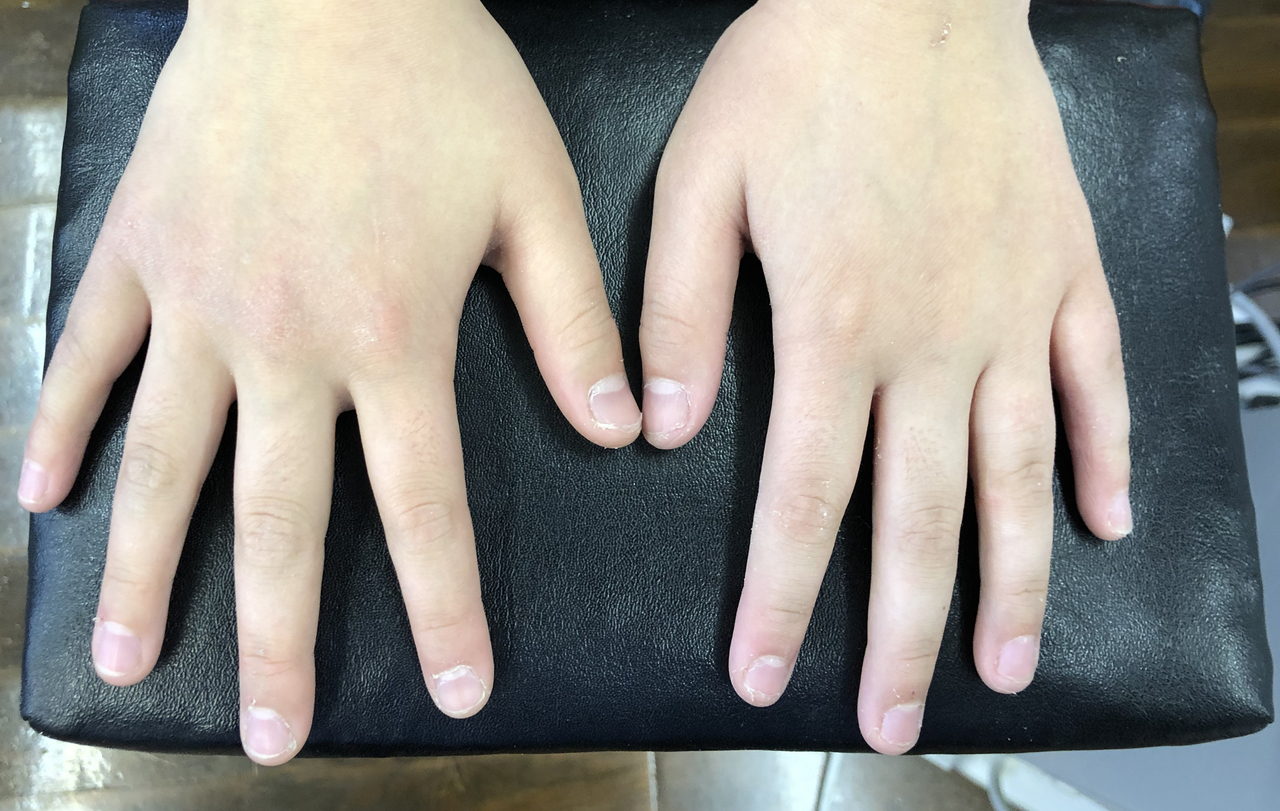 骨折の整復後、小指の変形が改善されています