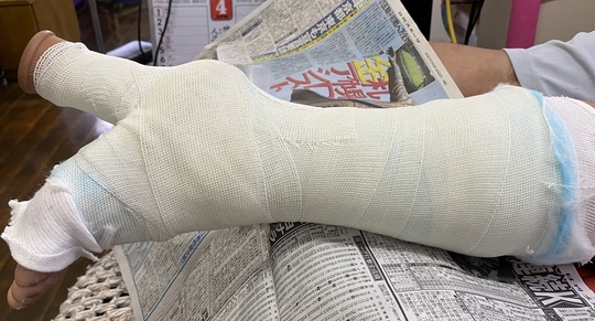 松葉杖があると出勤できない！東海市より新鮮アキレス腱断裂の方