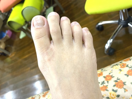 治療 足 の 指 骨折 足の指を骨折した場合(またはひび)の症状6つと対処法2選