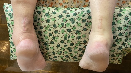 アキレス腱　断裂　 装具　左　術後　保存療法　レディース　女性 アキレス腱 断裂 装具 左 術後 保存療法 レディース 女性 アキレス腱