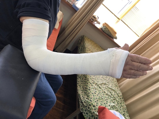 永田接骨院で行う骨折の保存療法、整復、固定法について-永田接骨院