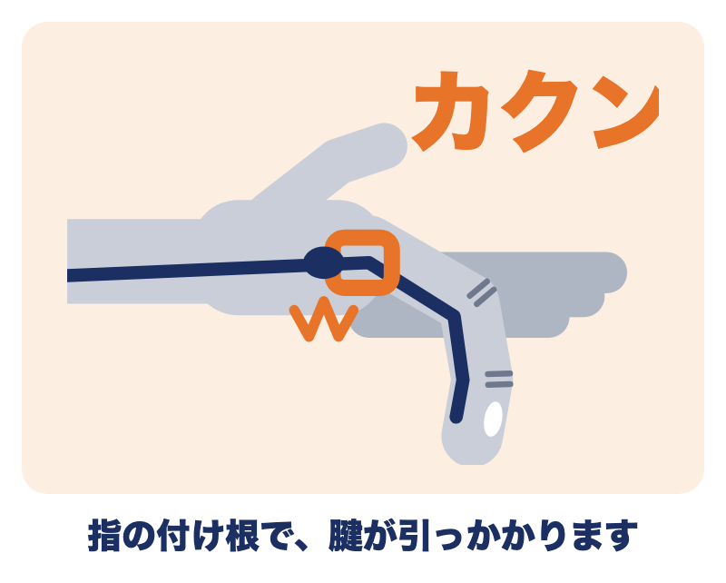 ばね指のしくみ：指の付け根の通り道（腱鞘）で、指を曲げる腱がカクンと引っかかる様子