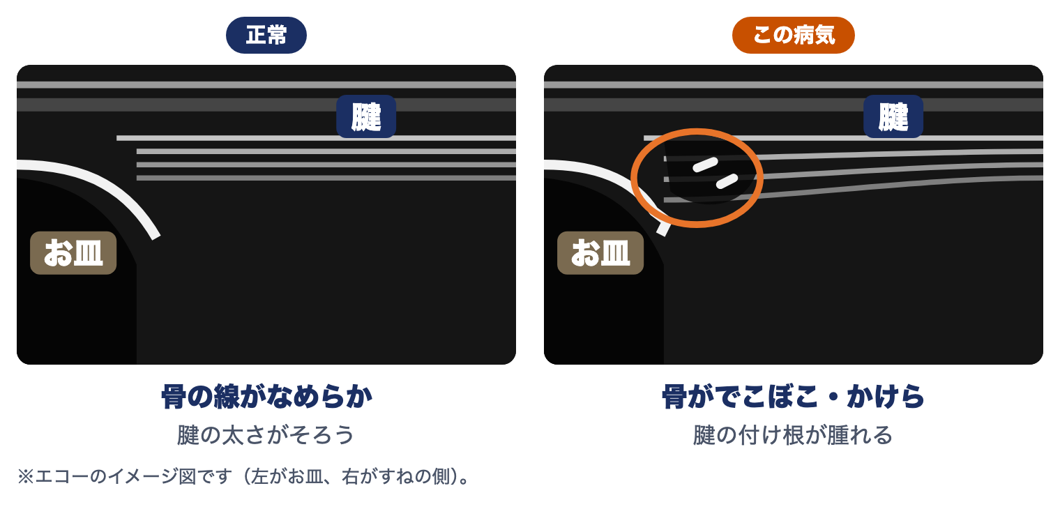 シンディング・ラーセン・ヨハンソン病のエコーのイメージ図：正常は骨の線がなめらか、この病気では骨がでこぼこ・かけらがあり、腱の付け根が腫れる