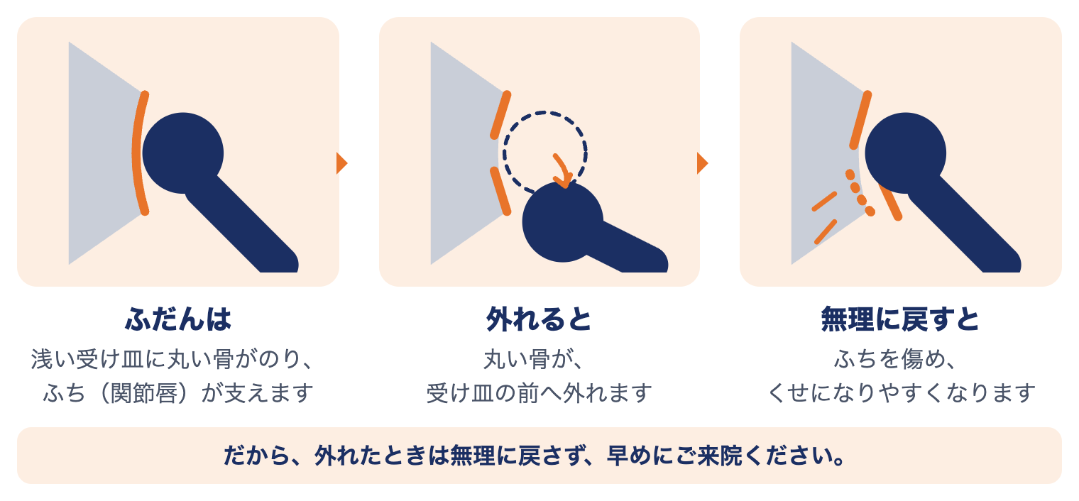 肩関節脱臼で肩の中で起きていること：ふだんは受け皿に丸い骨がのり、外れると前へ外れ、無理に戻すとふち（関節唇）を傷める
