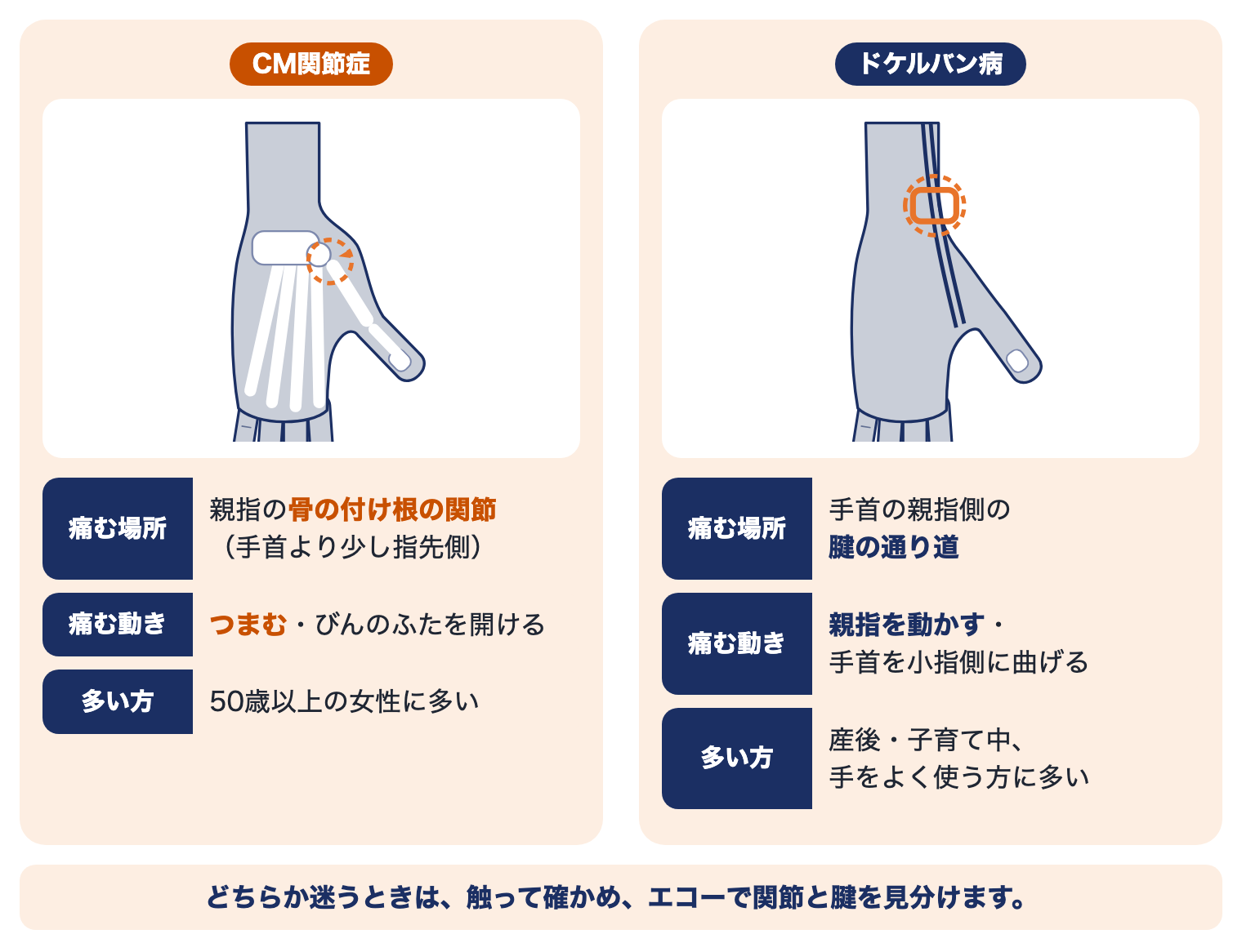 母指CM関節症とドケルバン病の違い：CM関節症は親指の付け根の関節がつまむと痛む、ドケルバン病は手首の親指側の腱の通り道が親指を動かすと痛む
