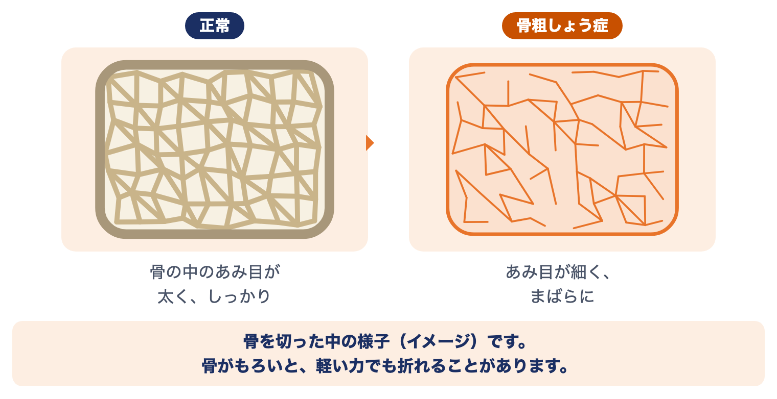 骨粗しょう症のしくみ：正常な骨は中のあみ目が太くしっかりしているが、骨粗しょう症ではあみ目が細くまばらになる（イメージ）