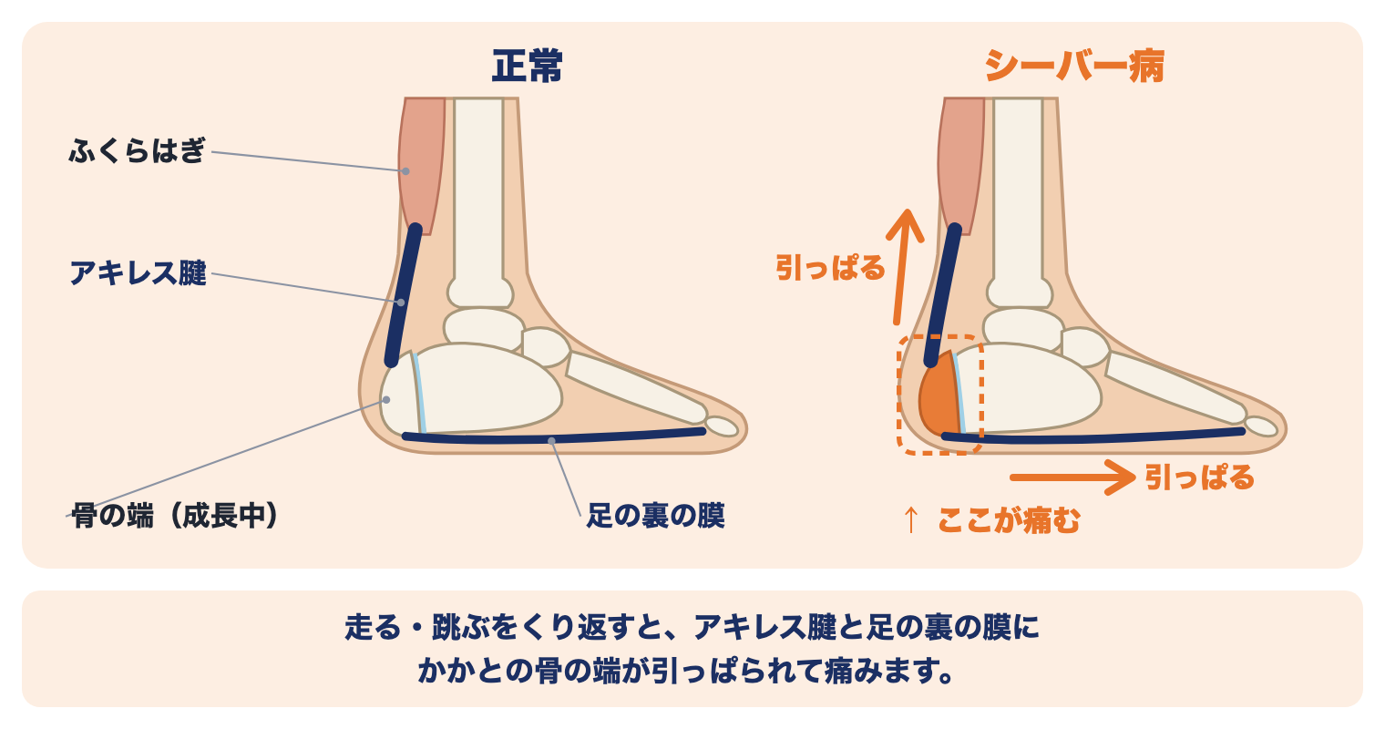 シーバー病の痛む場所：右足を内側から見た骨の絵で、正常なかかとと、シーバー病でアキレス腱と足の裏の膜にかかとの骨の端が引っぱられて痛む所