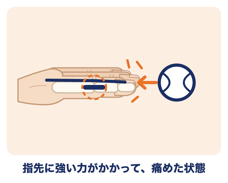 突き指とは：ボールなどで指先に強い力がかかり、指を痛めた状態