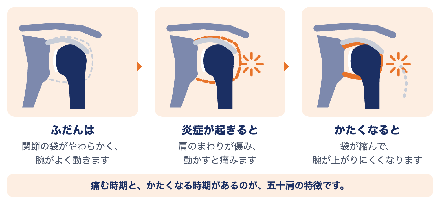 五十肩で肩に起きていること：ふだんは関節の袋がやわらかく、炎症が起きると痛み、かたくなると腕が上がりにくくなる