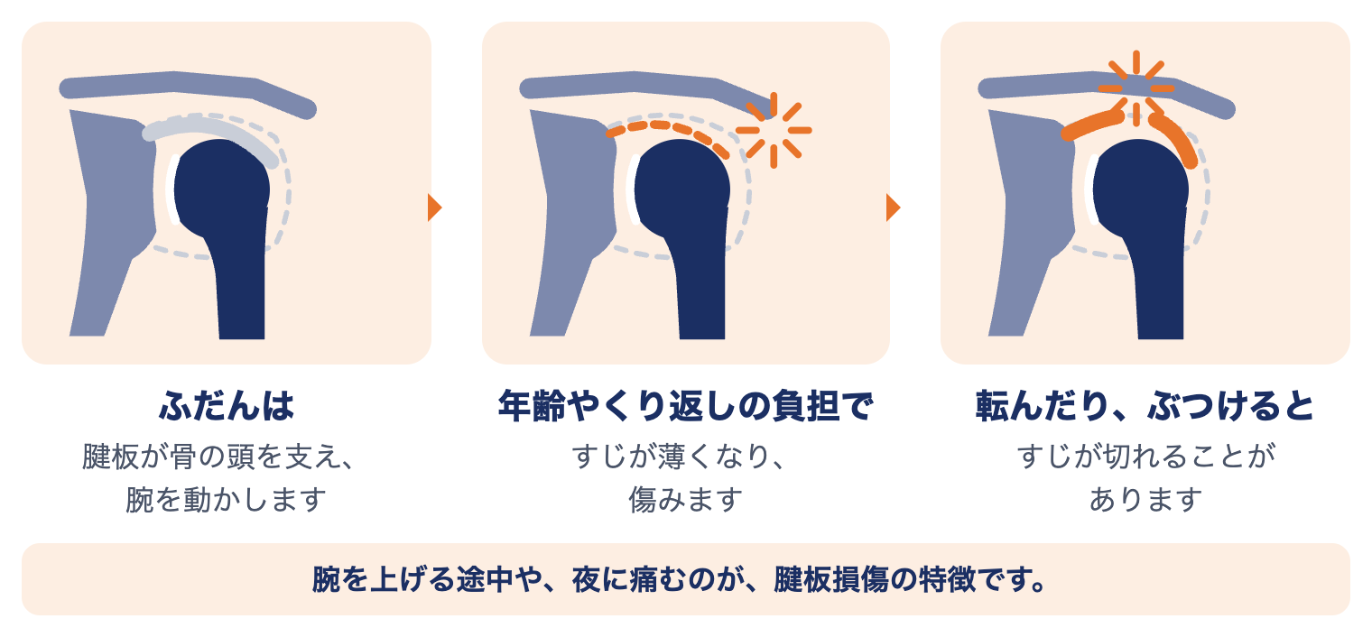 腱板損傷で肩に起きていること：ふだんは腱板が骨の頭を支え、年齢やくり返しの負担で傷み、転んだりぶつけると切れることがある