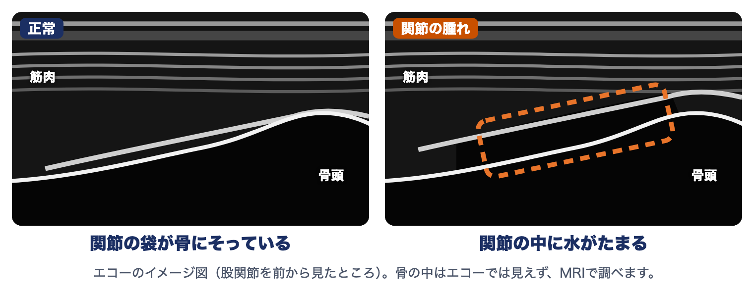 特発性大腿骨頭壊死症のエコー（イメージ図）：正常は関節の袋が骨にそっている、関節の腫れでは関節の中に水がたまる