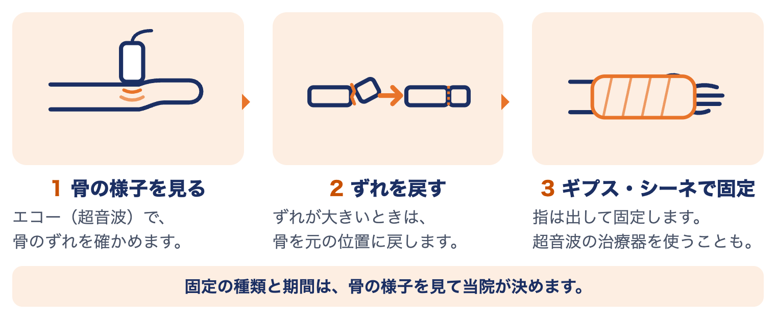 コーレス骨折の当院での治療の流れ：1 エコーで骨のずれを確かめる、2 ずれが大きいときは元の位置に戻す（整復）、3 ギプス・シーネで固定
