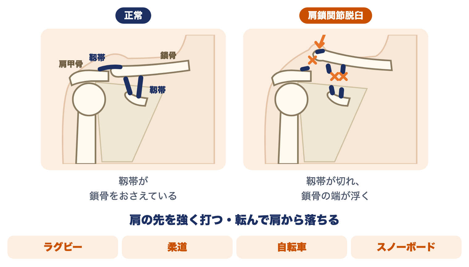 肩鎖関節脱臼の正常とけがの比べ：正常は靱帯が鎖骨をおさえ、肩鎖関節脱臼では靱帯が切れて鎖骨の端が浮く。ラグビー・柔道・自転車・スノーボードで、肩の先を強く打つ・肩から落ちると起こる