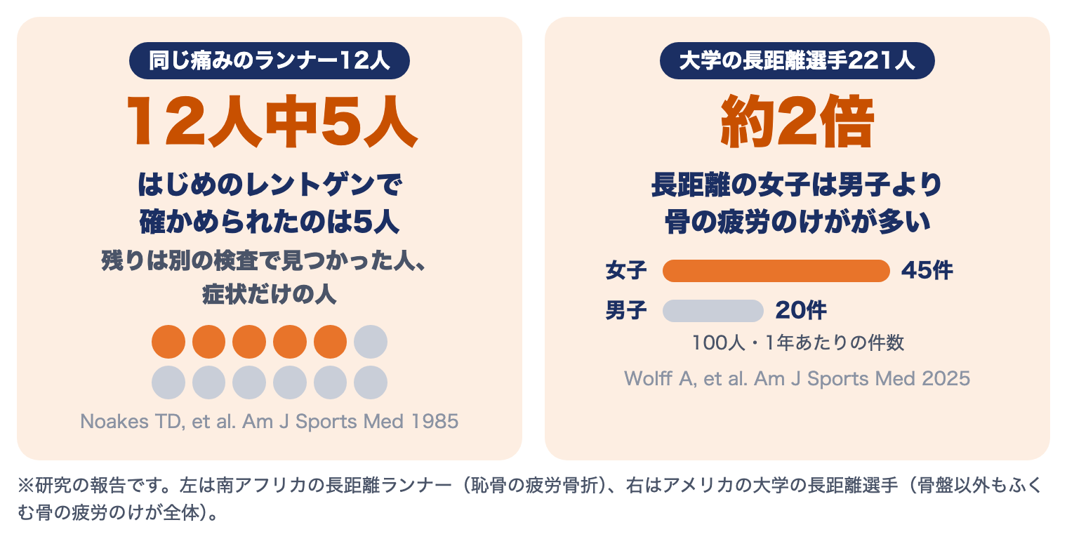 恥骨・坐骨の疲労骨折の研究：同じ痛みのランナー12人中、はじめのレントゲンで確かめられたのは5人。長距離の女子は男子の約2倍、骨の疲労のけがが多い