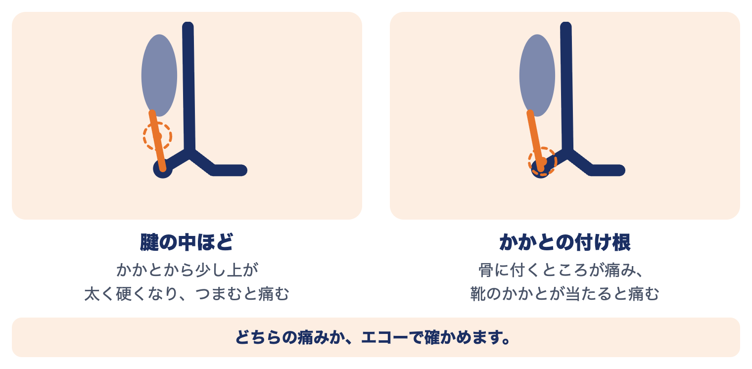 アキレス腱損傷の痛む場所：腱の中ほど（かかとから少し上）と、かかとの骨に付く付け根。どちらの痛みかエコーで確かめます