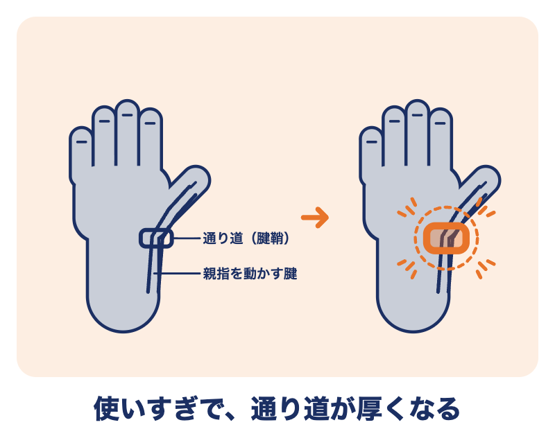ドケルバン病：使いすぎで手首の親指側の通り道が厚くなり、腱がこすれて痛む
