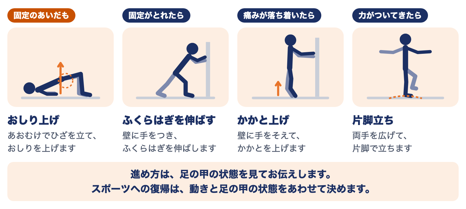 リスフラン関節損傷の運動療法（時期別）：固定のあいだはおしり上げ、固定がとれたらふくらはぎを伸ばす、痛みが落ち着いたらかかと上げ、力がついてきたら片脚立ち
