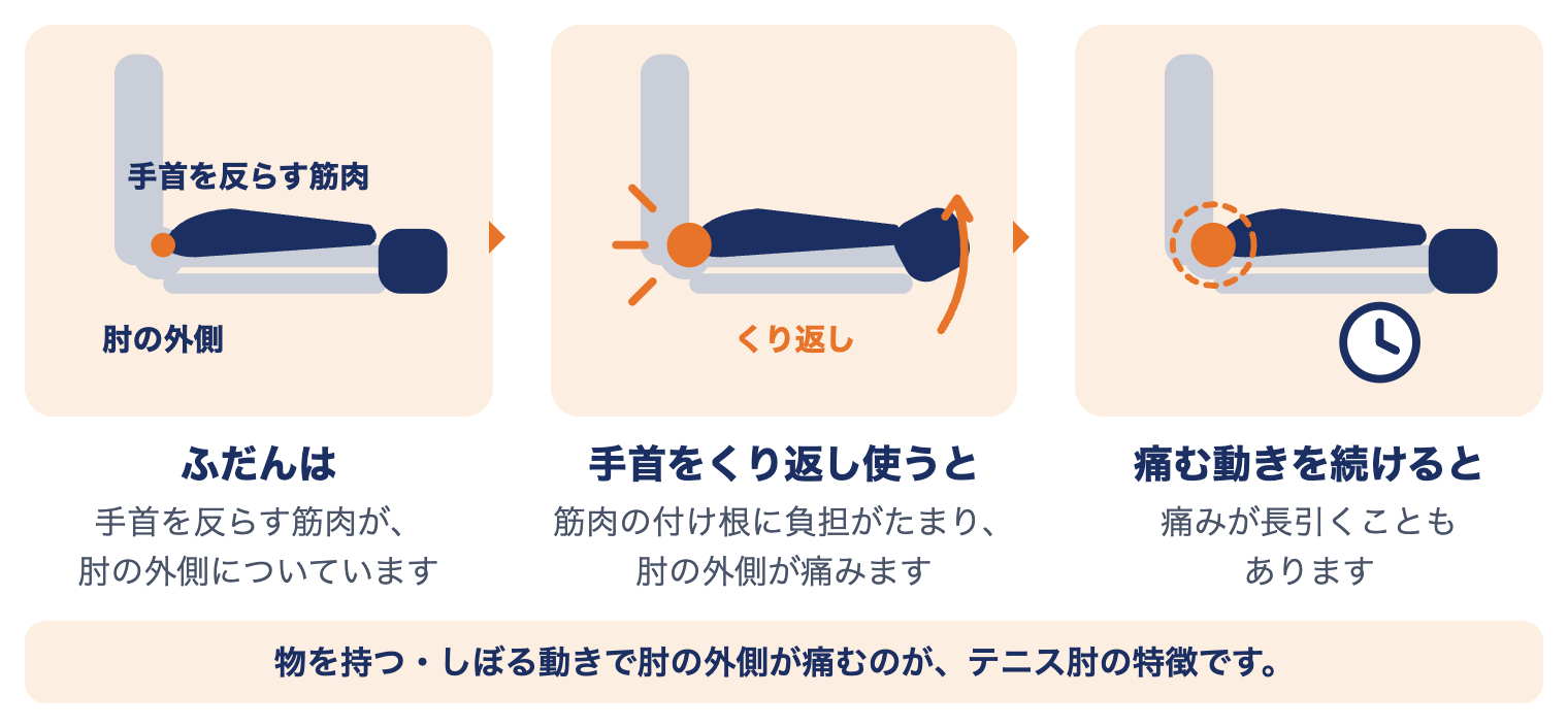 テニス肘で肘の外側に起きていること：手首を反らす筋肉が肘の外側についていて、手首をくり返し使うと付け根に負担がたまって痛み、痛む動きを続けると長引くこともある