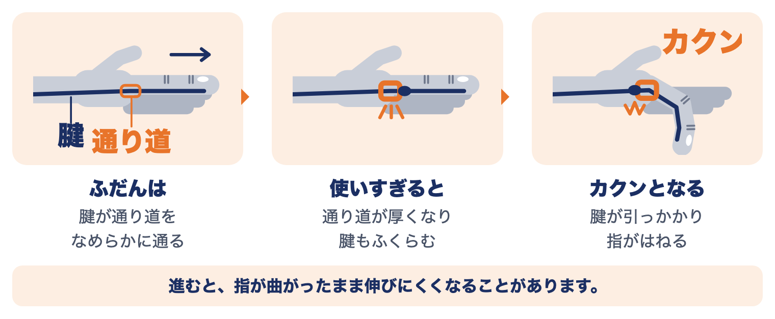 ばね指のしくみ：ふだんは腱が通り道をなめらかに通る、使いすぎると通り道が厚くなり腱もふくらむ、腱が引っかかり指がカクンとはねる