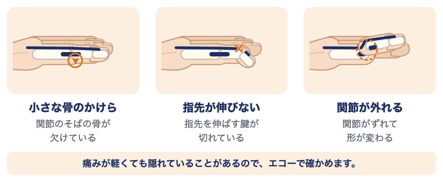 突き指に隠れていることがあるけが：小さな骨のかけら、指先が伸びない（指先を伸ばす腱が切れている）、関節が外れる