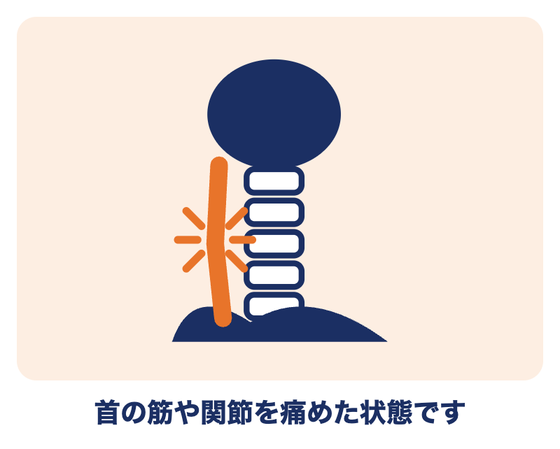 寝違えとは：首の筋や関節を痛めた状態