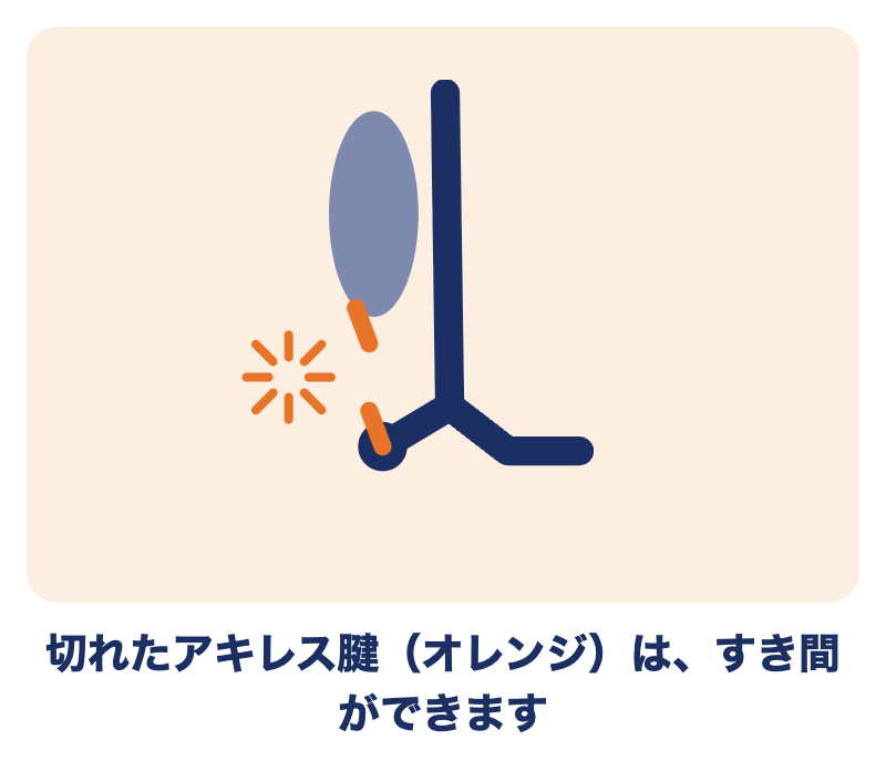切れたアキレス腱：すじのあいだにすき間ができる