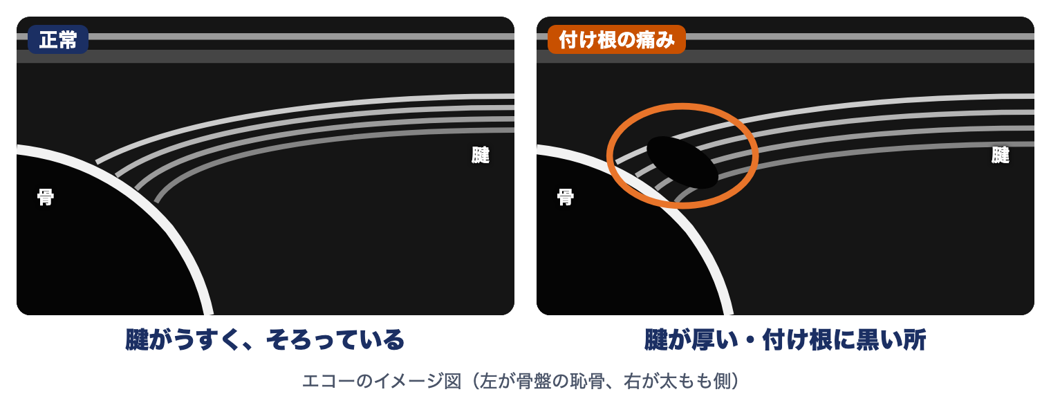 グローインペイン症候群のエコーのイメージ図：正常は腱がうすくそろっている、付け根の痛みでは腱が厚く付け根に黒い所