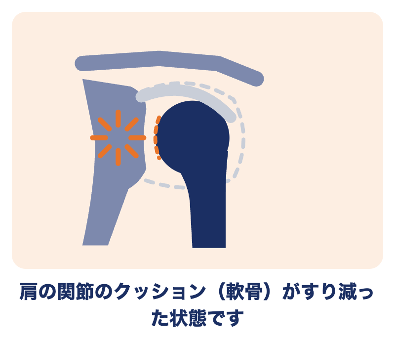 変形性肩関節症の肩：関節のクッション（軟骨）がすり減った状態