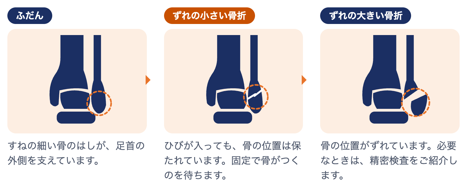 外果骨折で起きていること：ふだんは細い骨のはしが足首の外側を支え、ずれの小さい骨折は固定で骨がつくのを待ち、ずれの大きい骨折は精密検査をご紹介