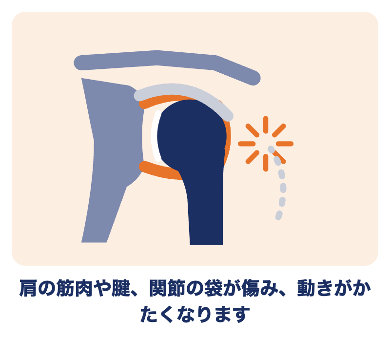 五十肩とは：肩の筋肉や腱、関節の袋が傷み、動きがかたくなる状態