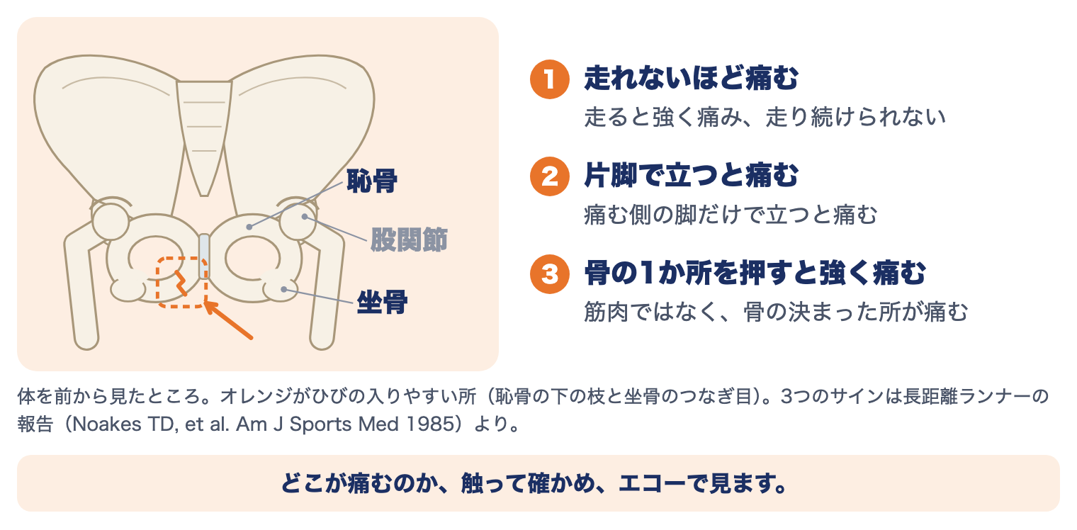 恥骨・坐骨の疲労骨折の痛む場所と見分けるポイント3つ：①走れないほど痛む②片脚で立つと痛む③骨の1か所を押すと強く痛む