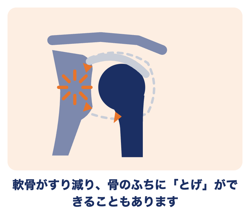 変形性肩関節症とは：軟骨がすり減り、骨のふちにとげができることもある