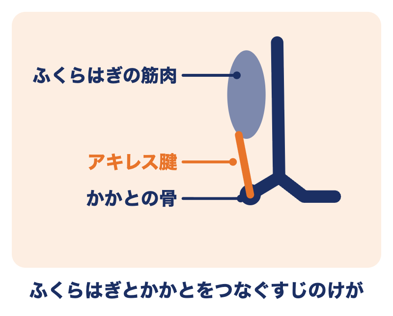 アキレス腱断裂の場所：ふくらはぎの筋肉とかかとの骨をつなぐ太いすじ（アキレス腱）