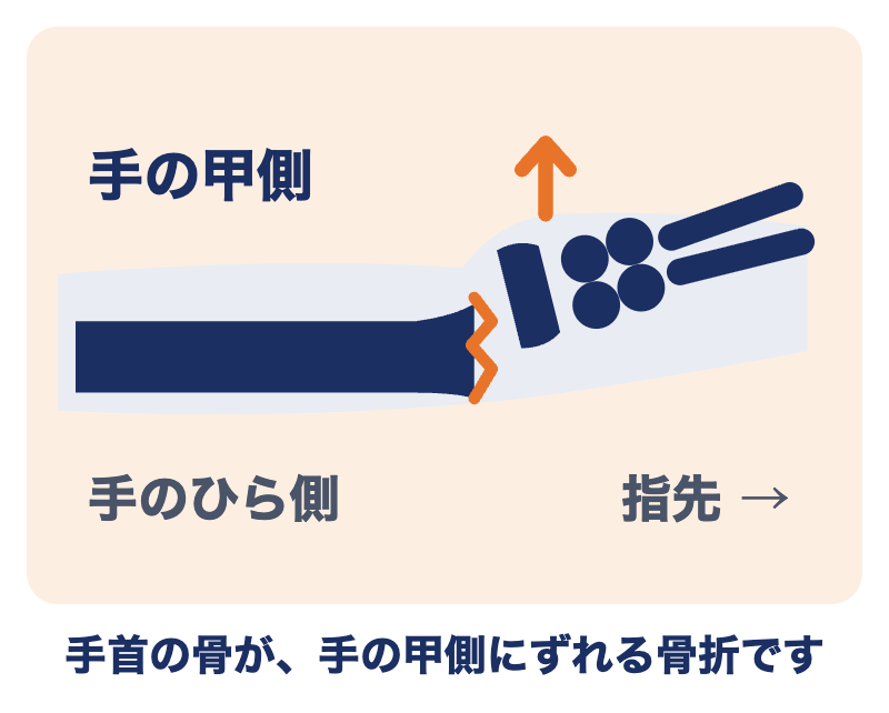 コーレス骨折：腕の骨（橈骨）の手首に近い所が折れ、手の甲側にずれた状態の図