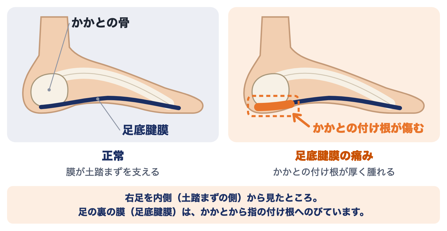 足底腱膜炎（足底腱膜の痛み）の痛む場所：右足を内側から見た絵で、正常では足の裏の膜が土踏まずを支え、足底腱膜の痛みでは膜のかかとの付け根が厚く腫れて傷む様子