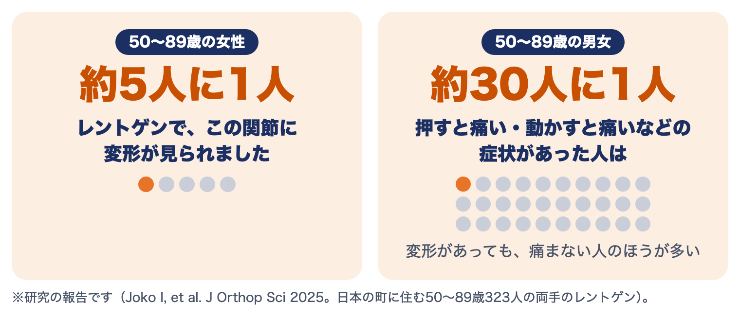 母指CM関節症の研究：50〜89歳の女性の約5人に1人にレントゲンで変形、症状のある人は約30人に1人