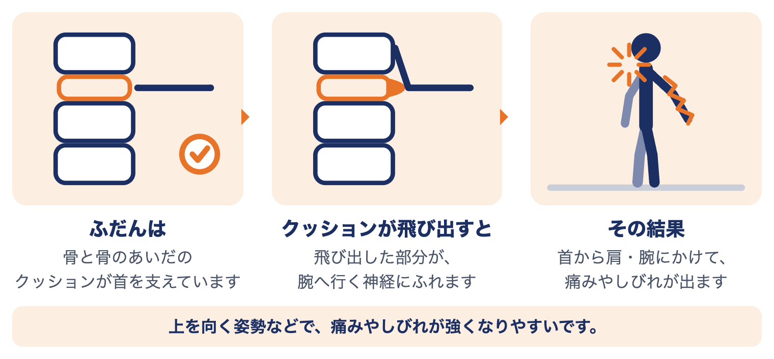 頚椎ヘルニアで首に起きていること：骨と骨のあいだのクッションが飛び出し、腕へ行く神経にふれ、首から肩・腕に痛みやしびれが出る