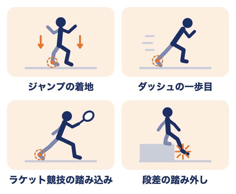 アキレス腱断裂が起こりやすい場面：ジャンプの着地、ダッシュの一歩目、ラケット競技の踏み込み、段差の踏み外し
