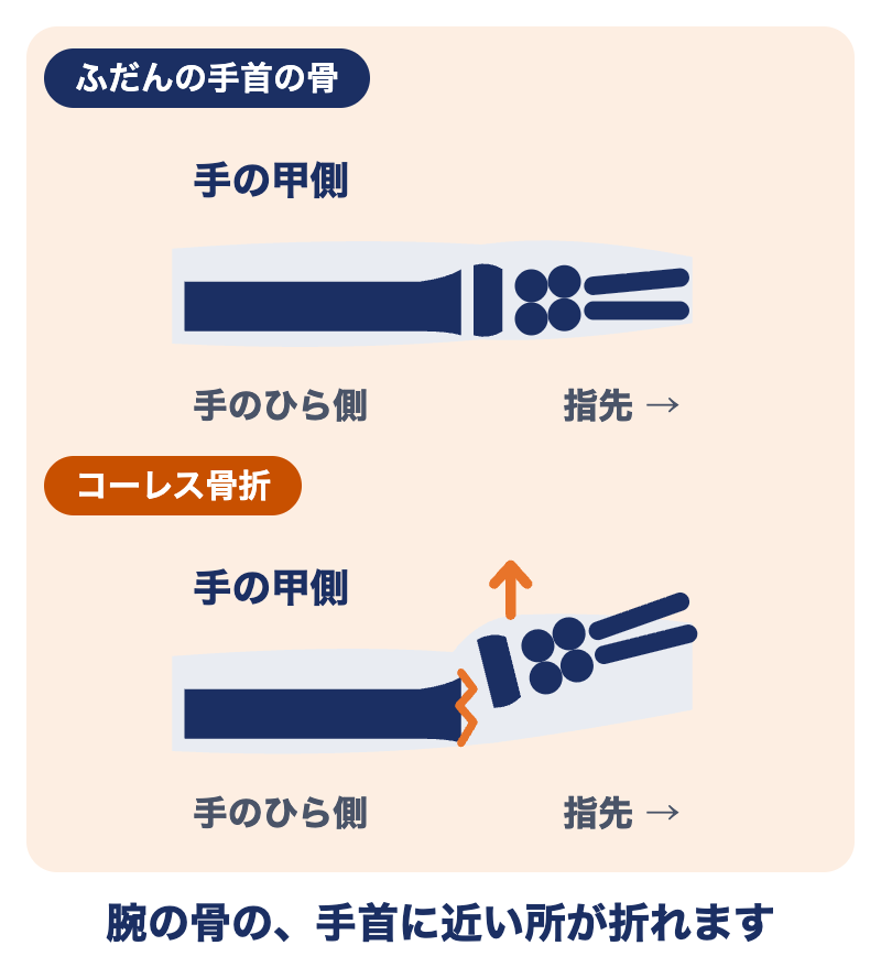 ふだんの手首の骨と、コーレス骨折（腕の骨の手首に近い所が折れ、手の甲側にずれる）の比較図