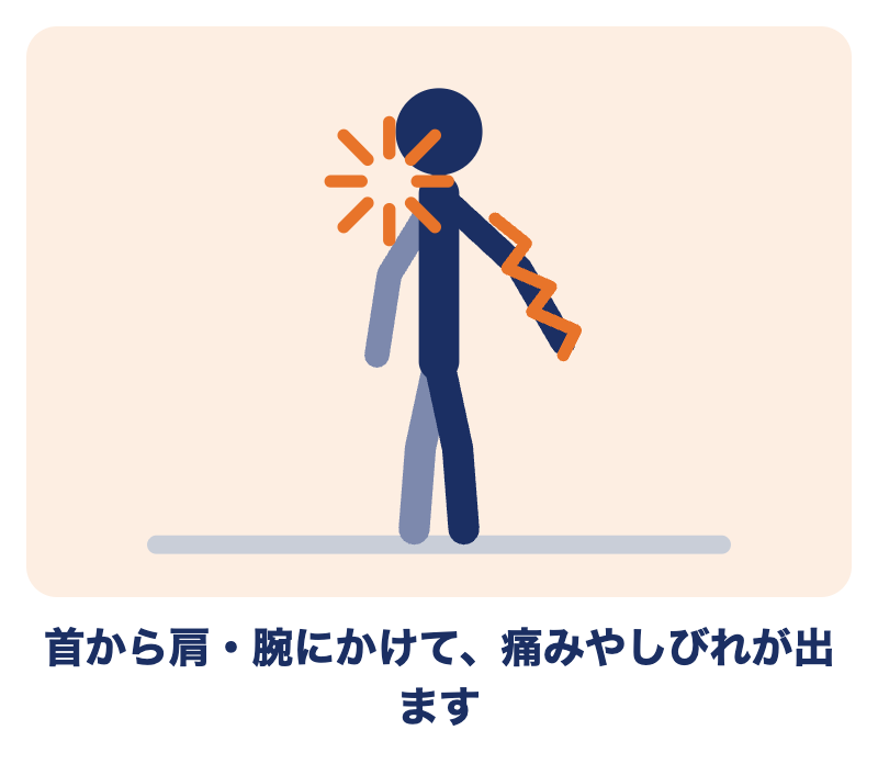頚椎症性神経根症：首から肩・腕にかけて痛みやしびれが出る