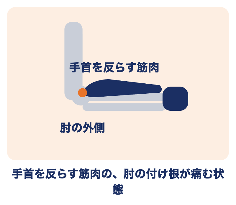 テニス肘とは：手首を反らす筋肉の、肘の外側の付け根が痛む状態