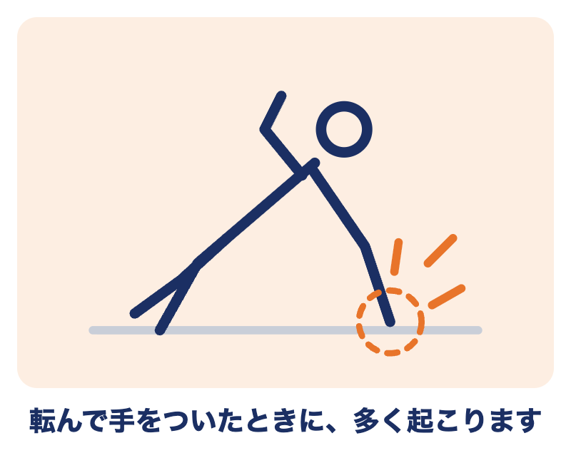 コーレス骨折は、転んで手をついたときに多く起こる（転んで手をつく人の絵）