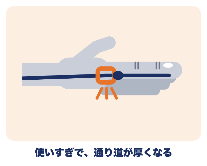 ばね指とは：使いすぎで指の付け根の通り道（腱鞘）が厚くなる様子