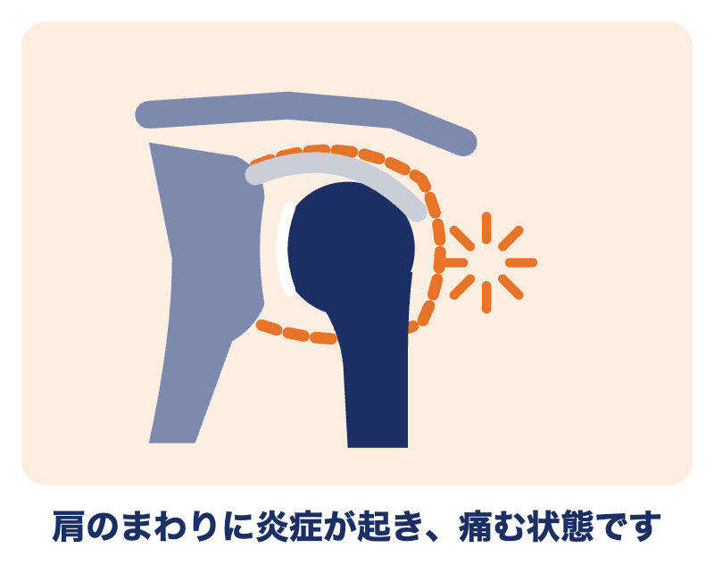 五十肩の肩：肩のまわりに炎症が起き、痛む状態