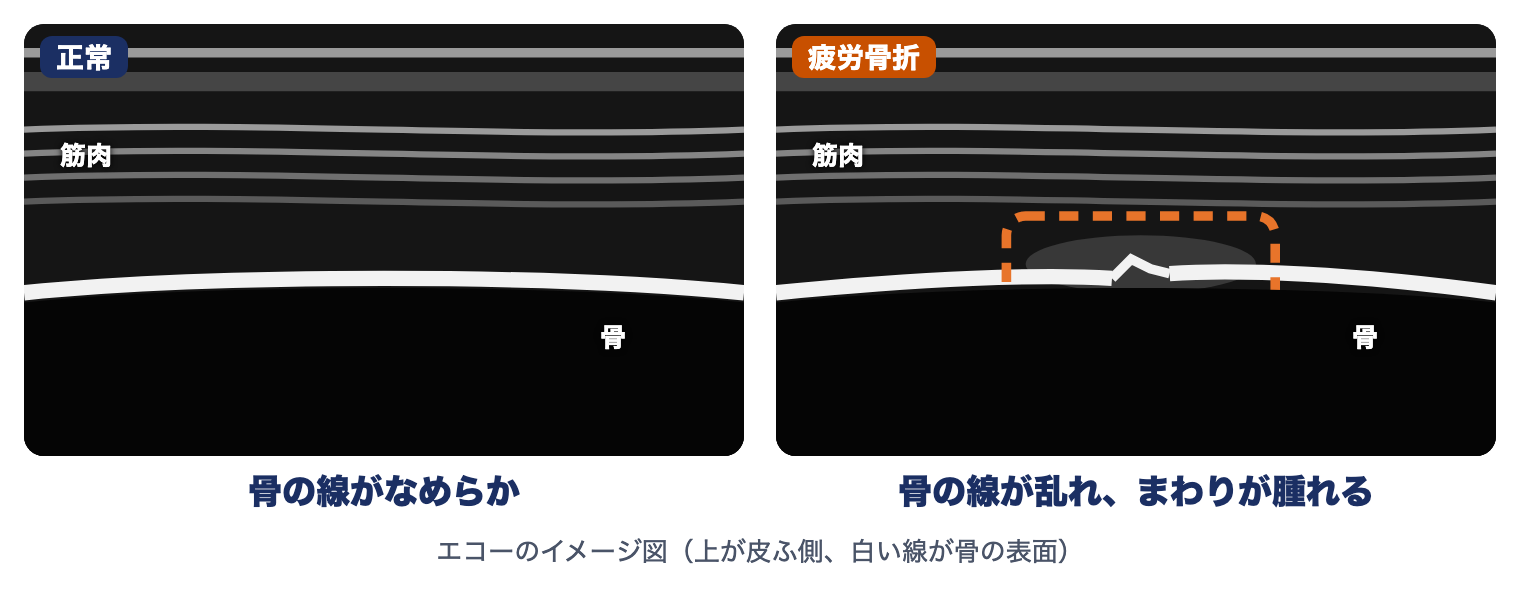 恥骨・坐骨の疲労骨折のエコーのイメージ図：正常は骨の線がなめらか、疲労骨折では骨の線が乱れてまわりが腫れる