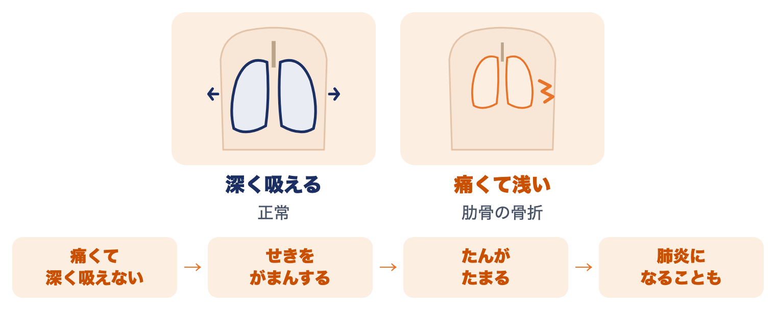 肋骨骨折で息が浅くなるしくみ：痛くて深く吸えない、せきをがまんする、たんがたまる、肺炎になることもある