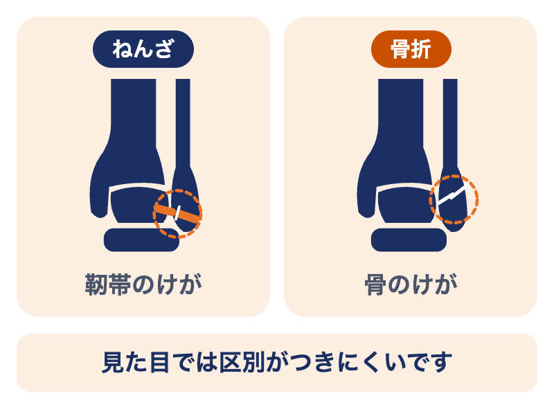 外果骨折とねんざの違い：ねんざは靭帯のけが、外くるぶしの骨折は骨にひびや割れが入るけが。どちらも外くるぶしが腫れて痛む