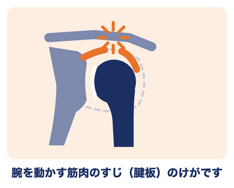腱板損傷の肩：腕を動かす筋肉のすじ（腱板）が切れた状態